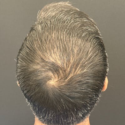 Hair PRP Before & After Gallery - Patient 172999 - Image 2