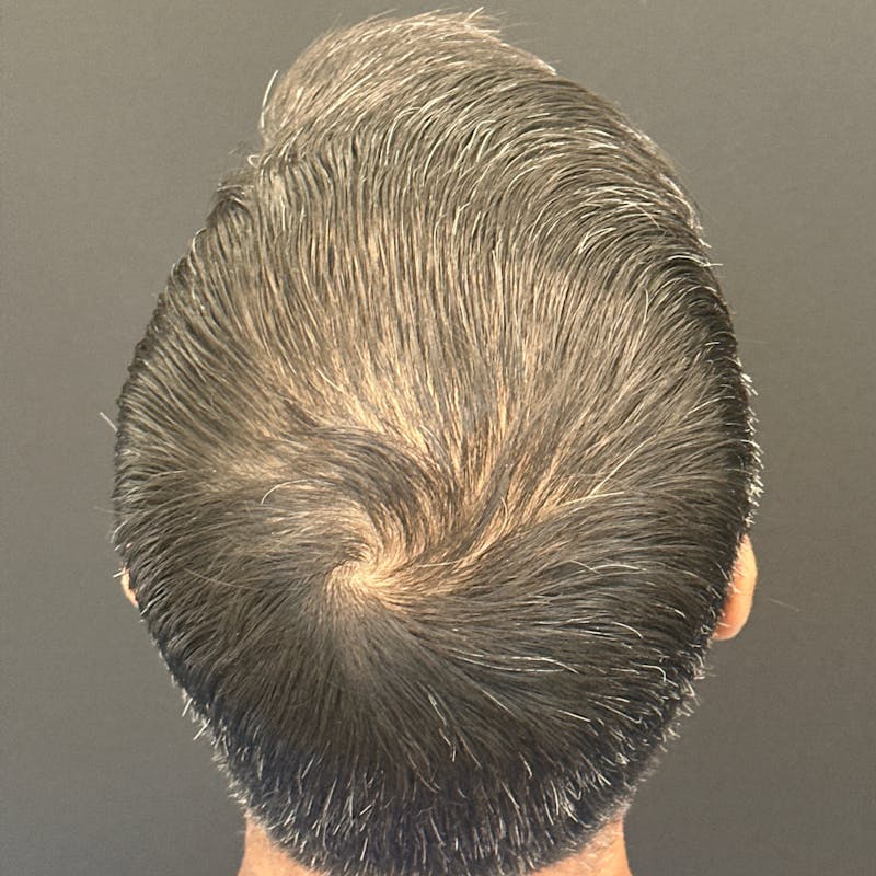 Hair PRP Before & After Gallery - Patient 172999 - Image 2