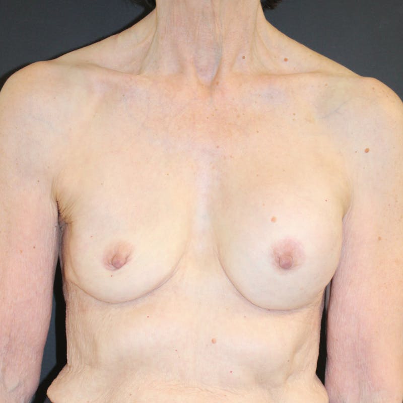 Implant Exchange Before & After Gallery - Patient 179721 - Image 3