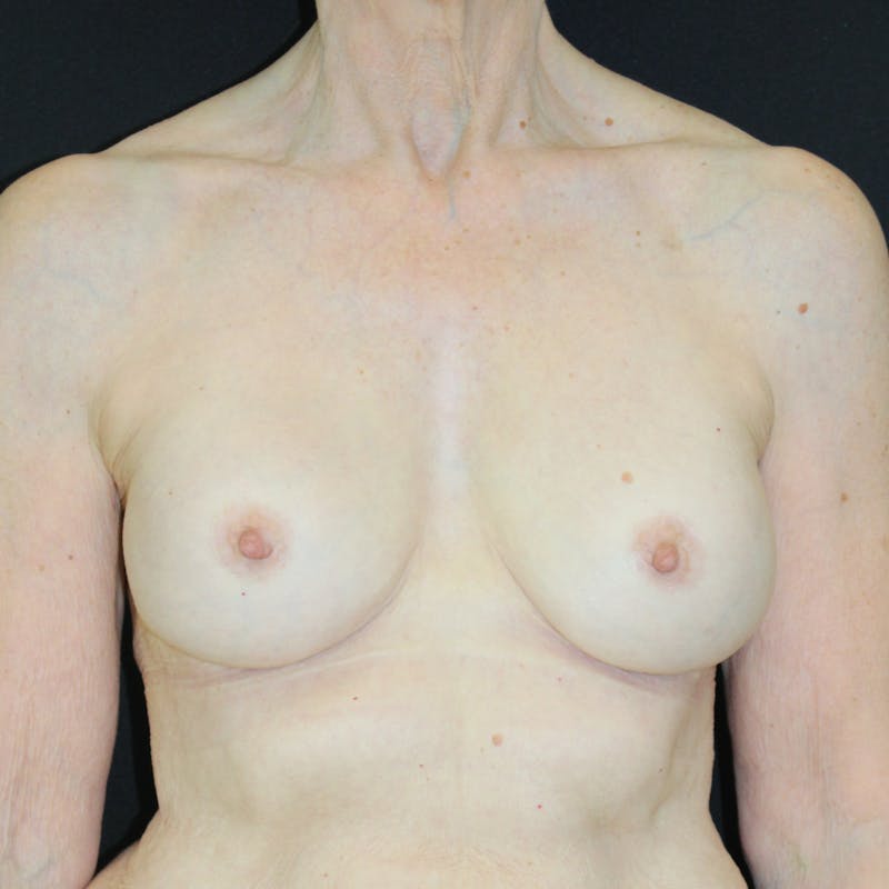 Implant Exchange Before & After Gallery - Patient 179721 - Image 4