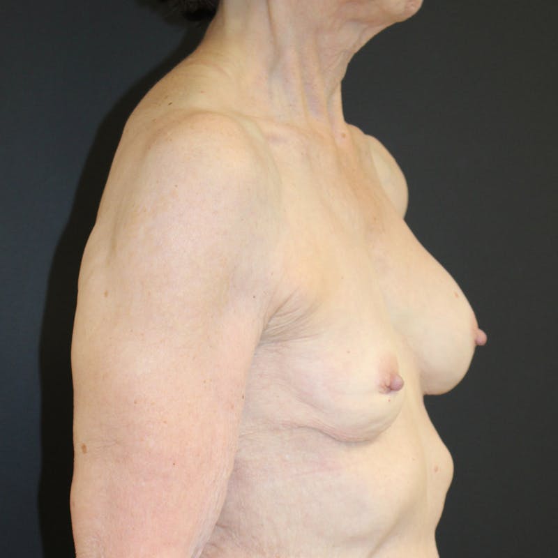 Implant Exchange Before & After Gallery - Patient 179721 - Image 1