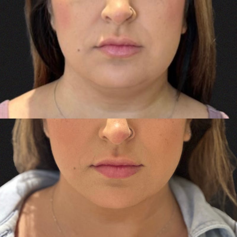 Liposuction Before & After Gallery - Patient 297085 - Image 3