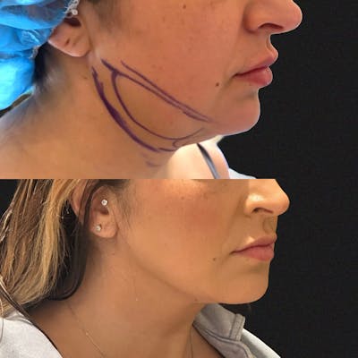 Liposuction Before & After Gallery - Patient 297085 - Image 2