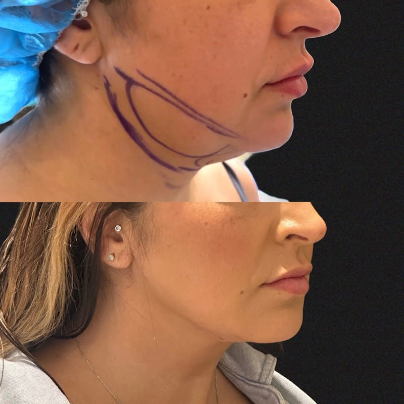 Liposuction Before & After Gallery - Patient 297085 - Image 2
