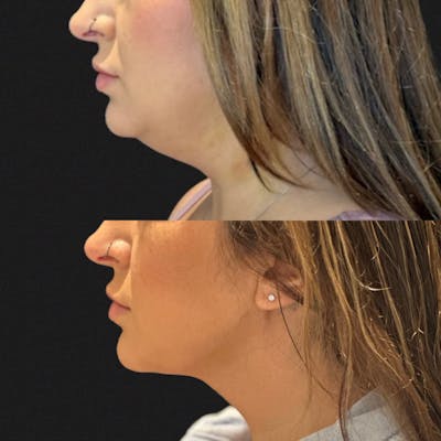 Liposuction Before & After Gallery - Patient 297085 - Image 1