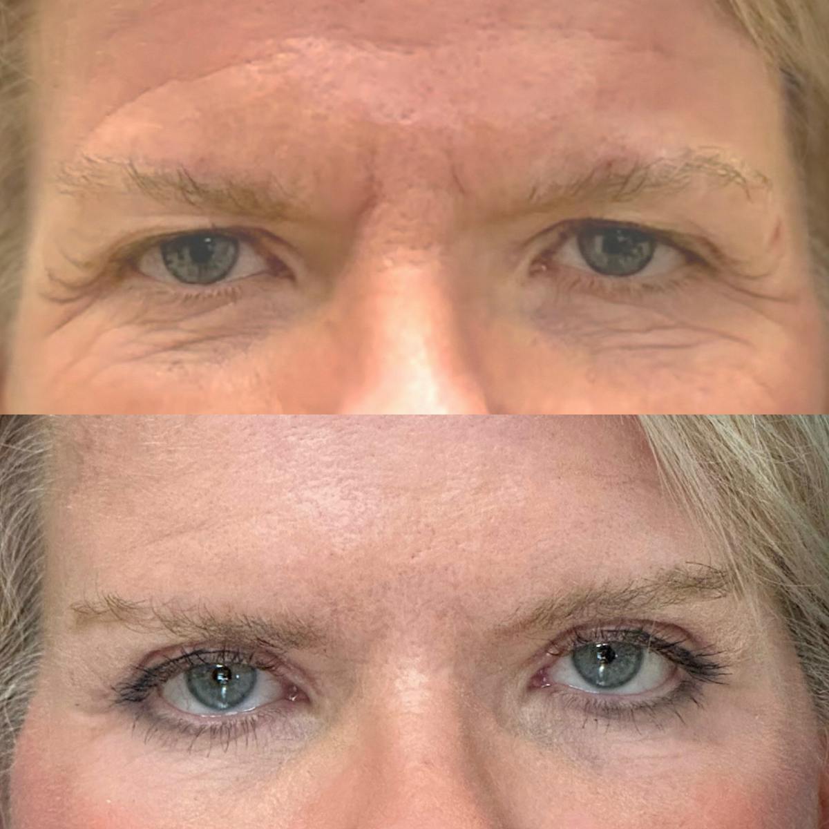 Eyelid Surgery (Blepharoplasty) Before & After Gallery - Patient 177826 - Image 1