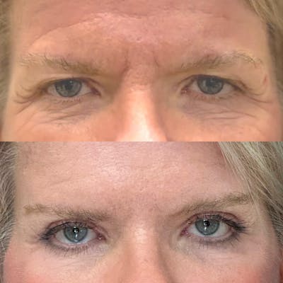 Eyelid Surgery (Blepharoplasty) Before & After Gallery - Patient 177826 - Image 1