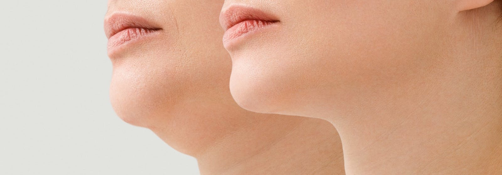 before and after photographic illustration of double chin reduction or removal surgery