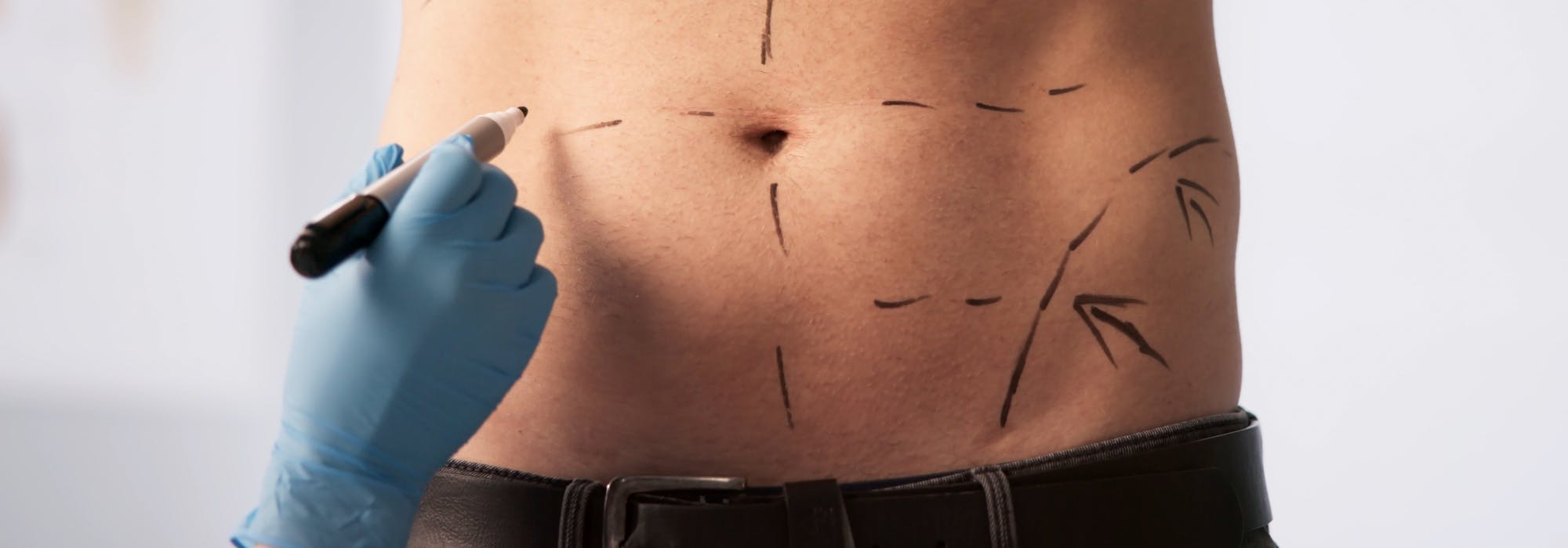 male patient body being marked up for a cosmetic surgery tummy tuck