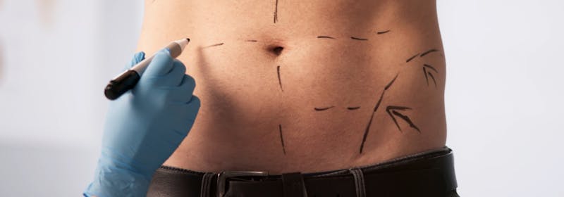 male patient body being marked up for a cosmetic surgery tummy tuck