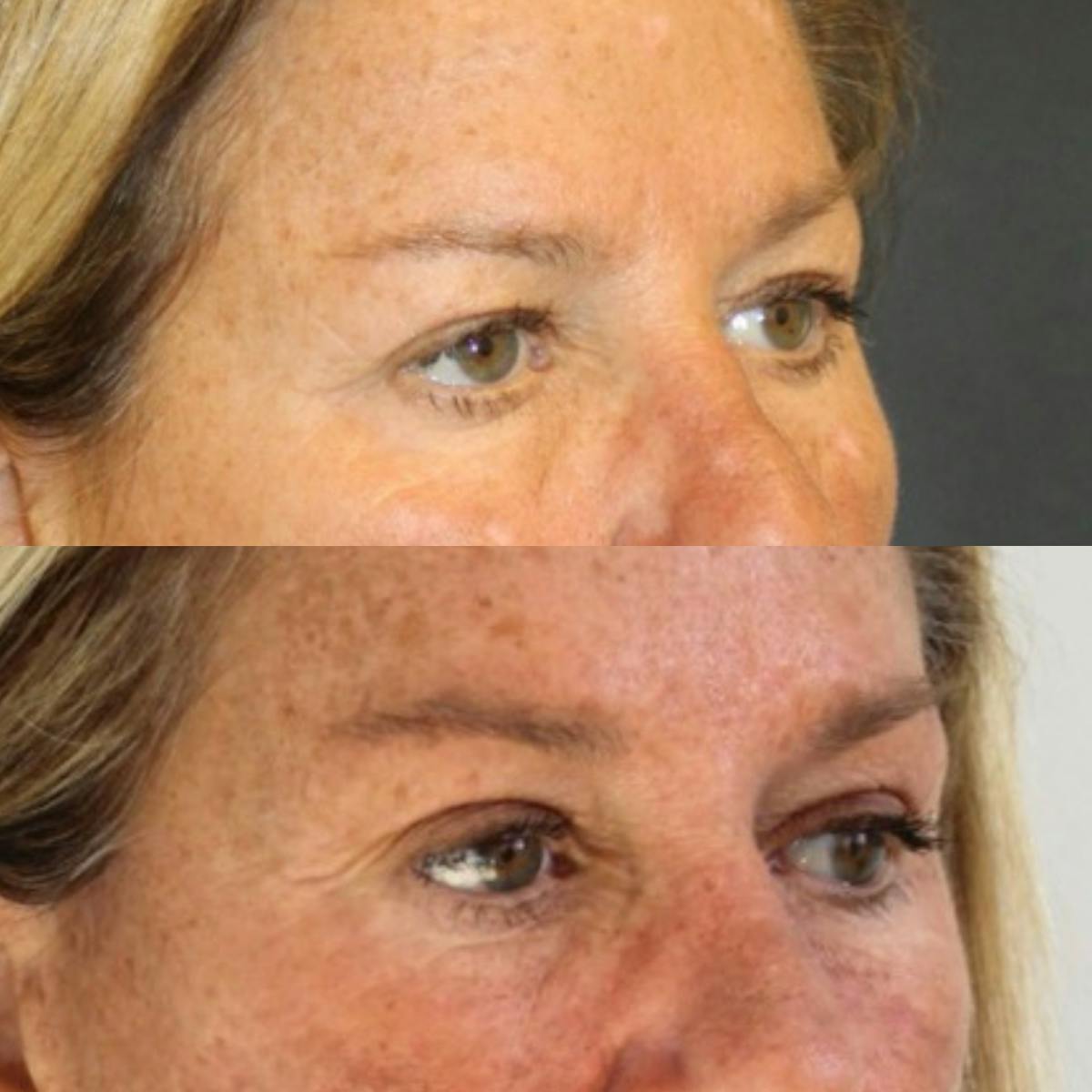 Eyelid Surgery (Blepharoplasty) Before & After Gallery - Patient 100174 - Image 1