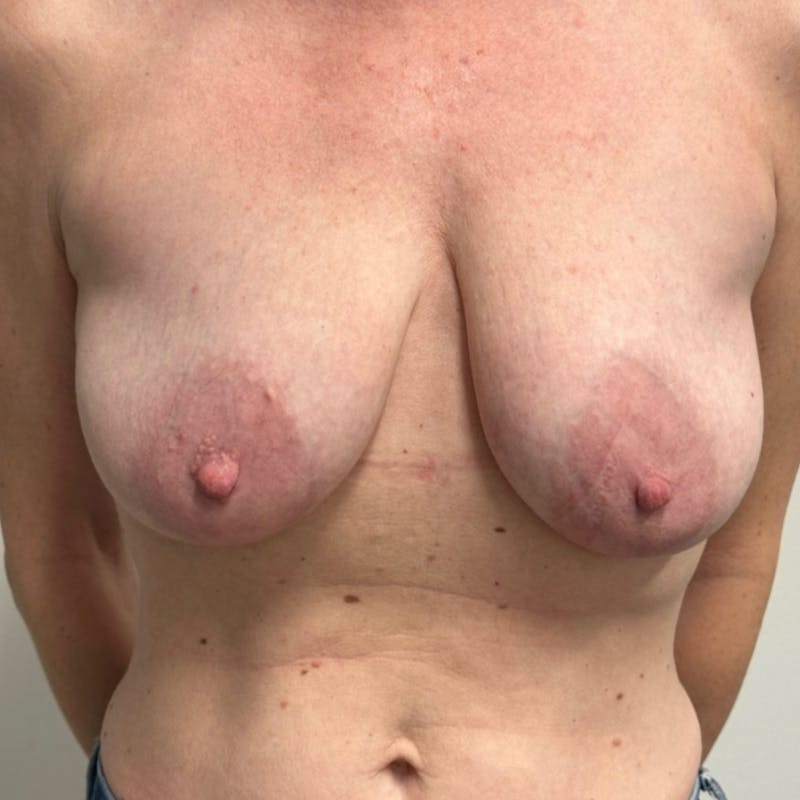 Breast Lift Before & After Gallery - Patient 112011 - Image 1