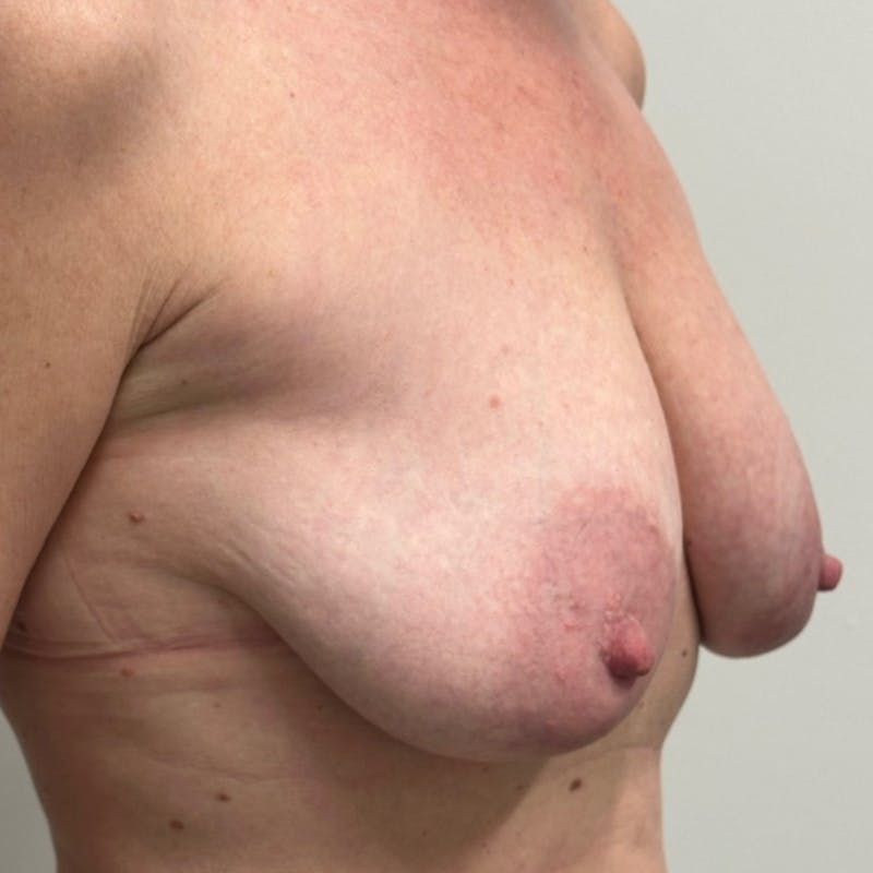 Breast Lift Before & After Gallery - Patient 112011 - Image 3
