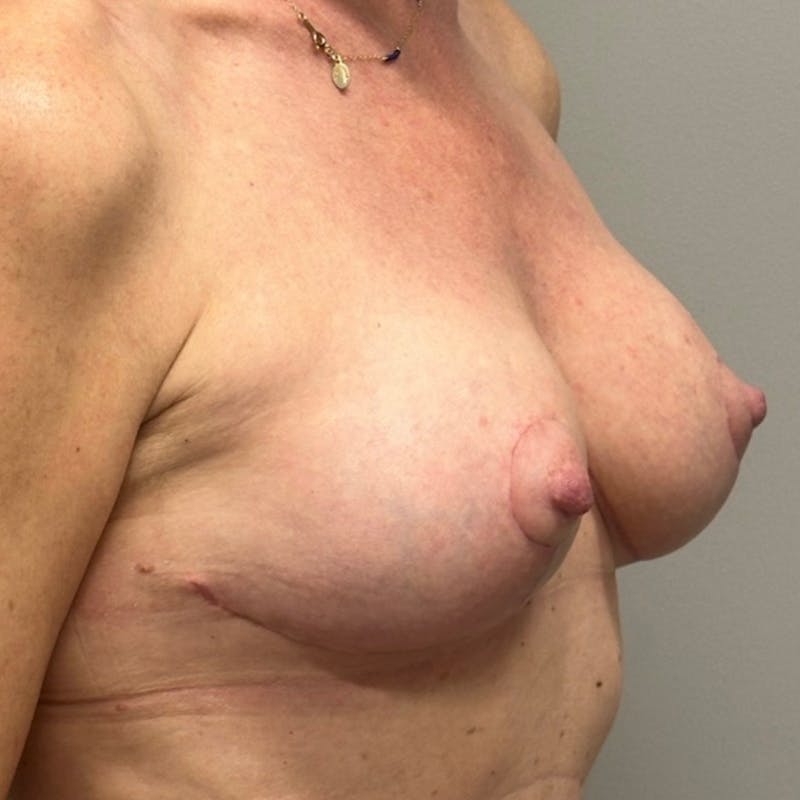 Breast Lift Before & After Gallery - Patient 112011 - Image 4