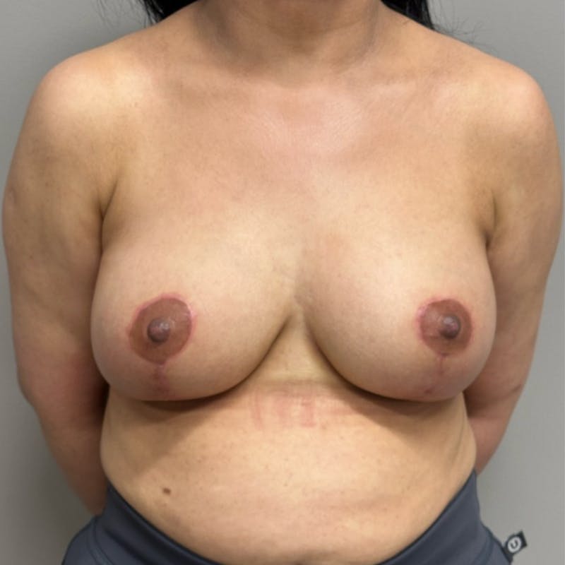 Breast Lift Before & After Gallery - Patient 408763 - Image 2