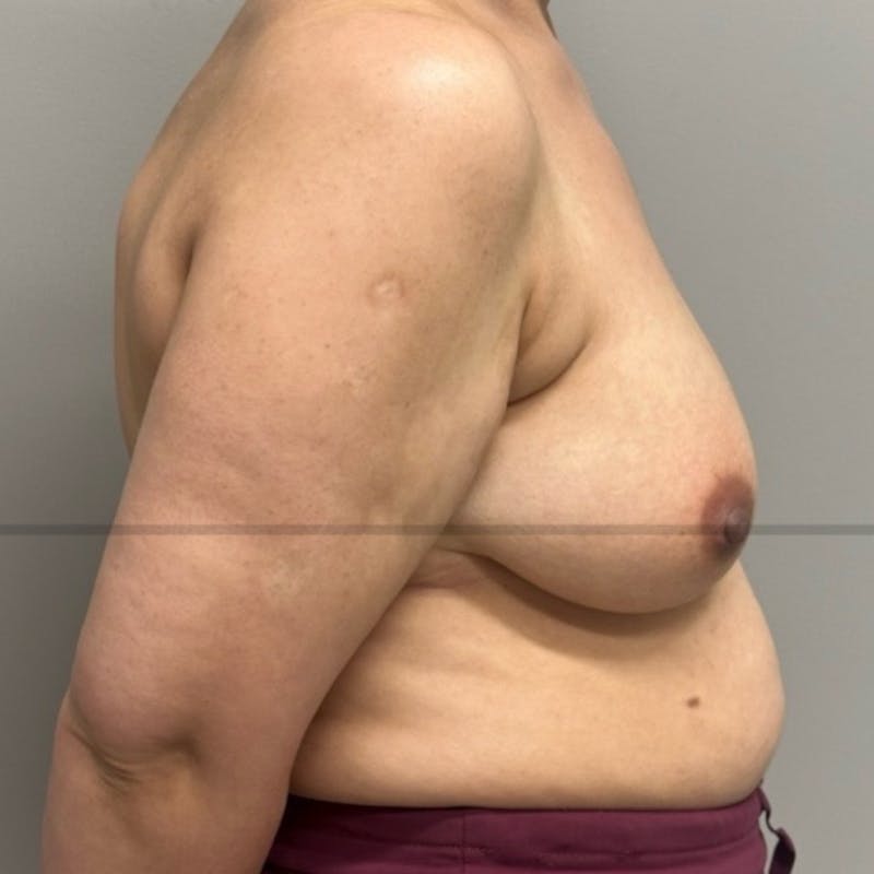 Breast Lift Before & After Gallery - Patient 408763 - Image 3