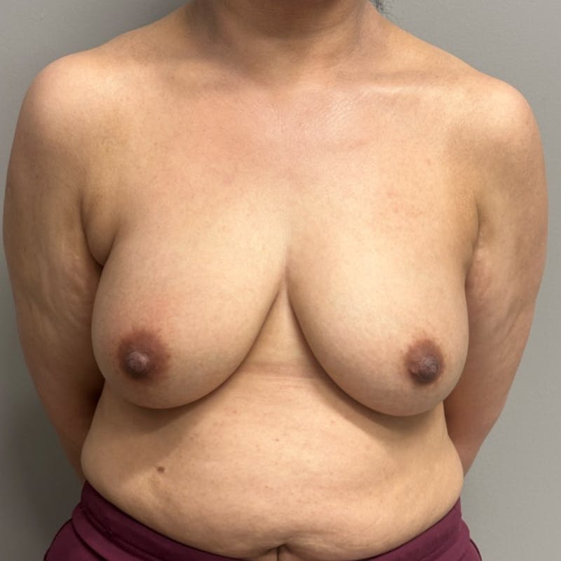 Breast Lift Before & After Gallery - Patient 408763 - Image 1