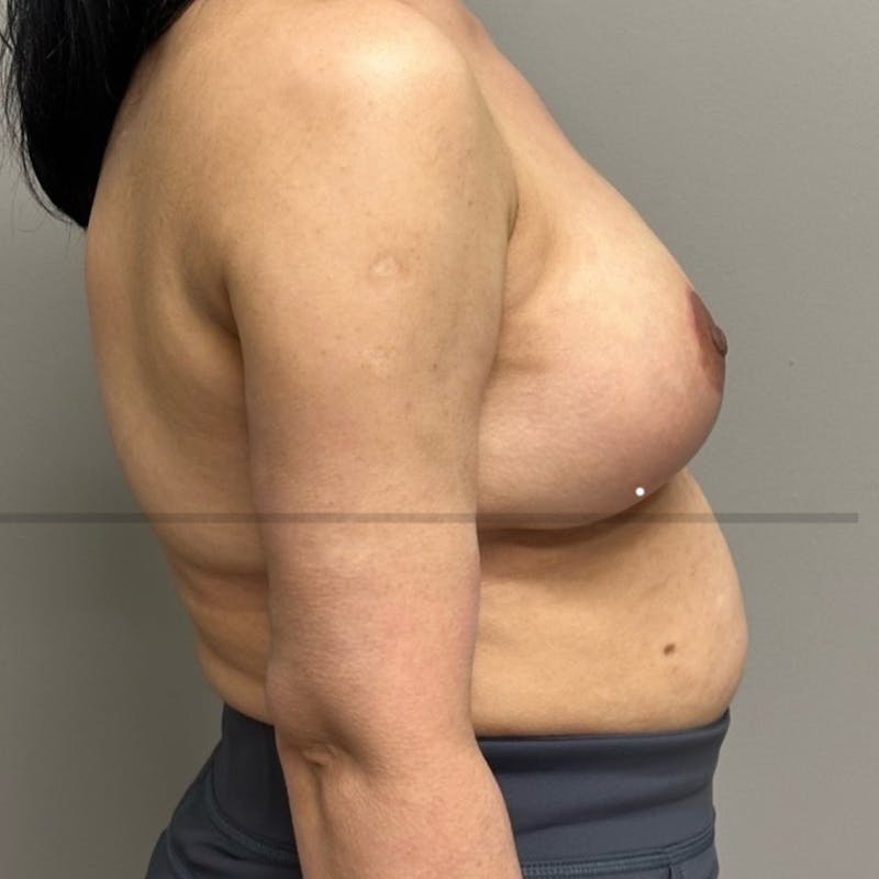 Breast Lift Before & After Gallery - Patient 408763 - Image 4