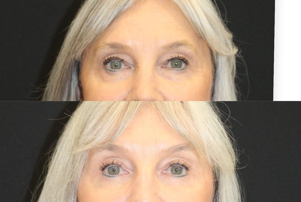 Eyelid Surgery (Blepharoplasty) Before & After Gallery - Patient 365347 - Image 2