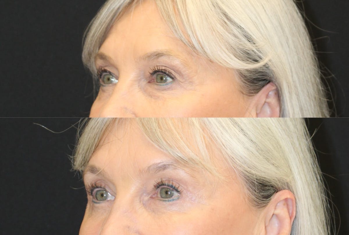 Eyelid Surgery (Blepharoplasty) Before & After Gallery - Patient 365347 - Image 1