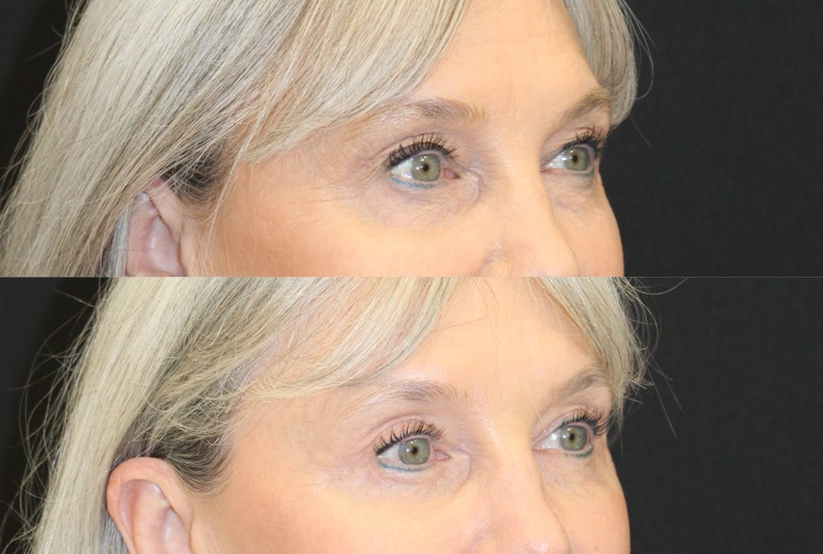 Eyelid Surgery (Blepharoplasty) Before & After Gallery - Patient 365347 - Image 3