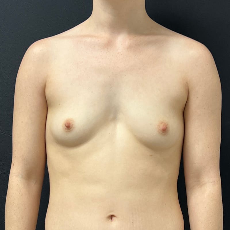 alloClae Before & After Gallery - Patient 208335 - Image 1