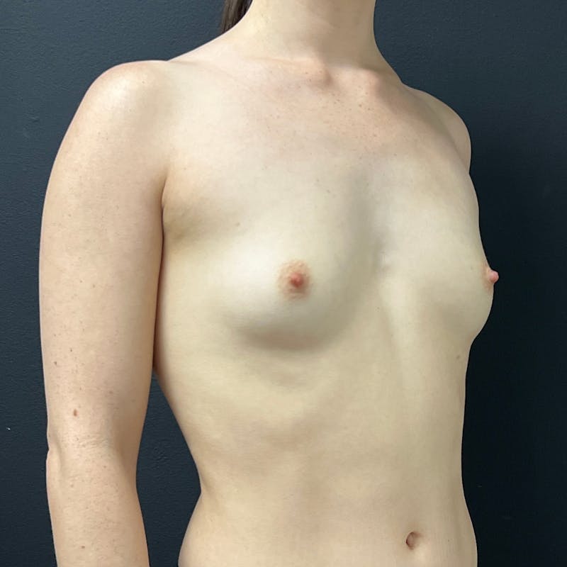 alloClae Before & After Gallery - Patient 208335 - Image 3