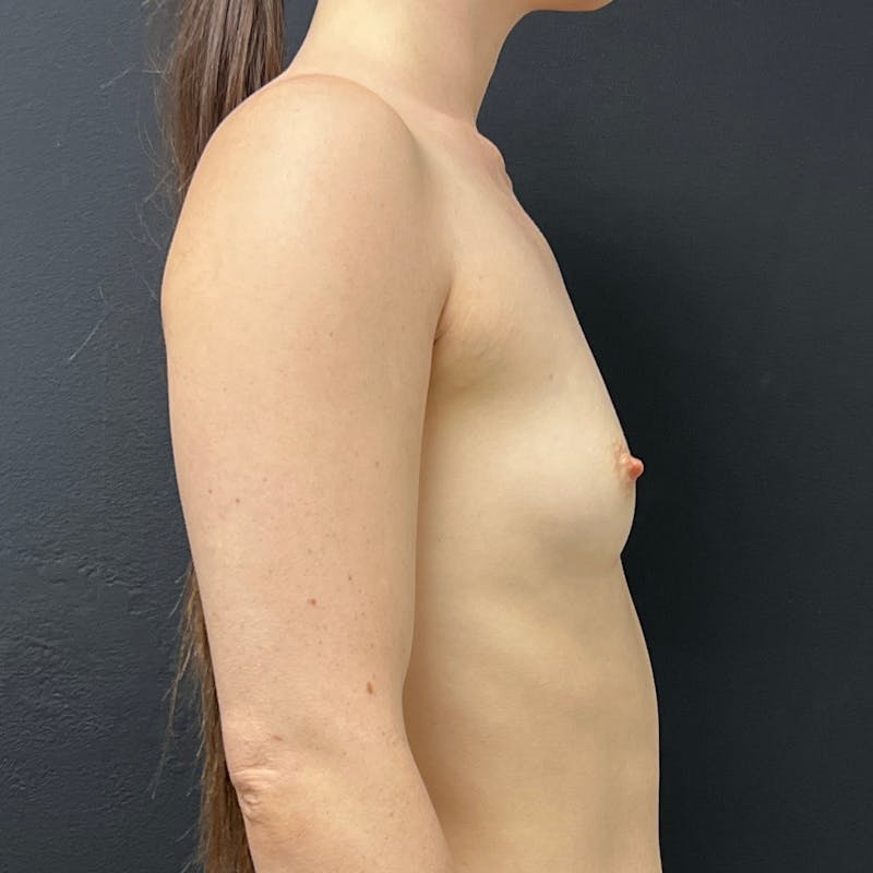 alloClae Before & After Gallery - Patient 208335 - Image 5