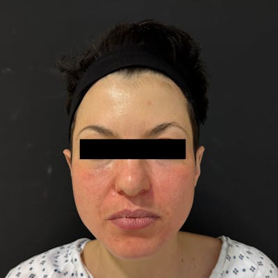 Fat Transfer Before & After Gallery - Patient 341514 - Image 1