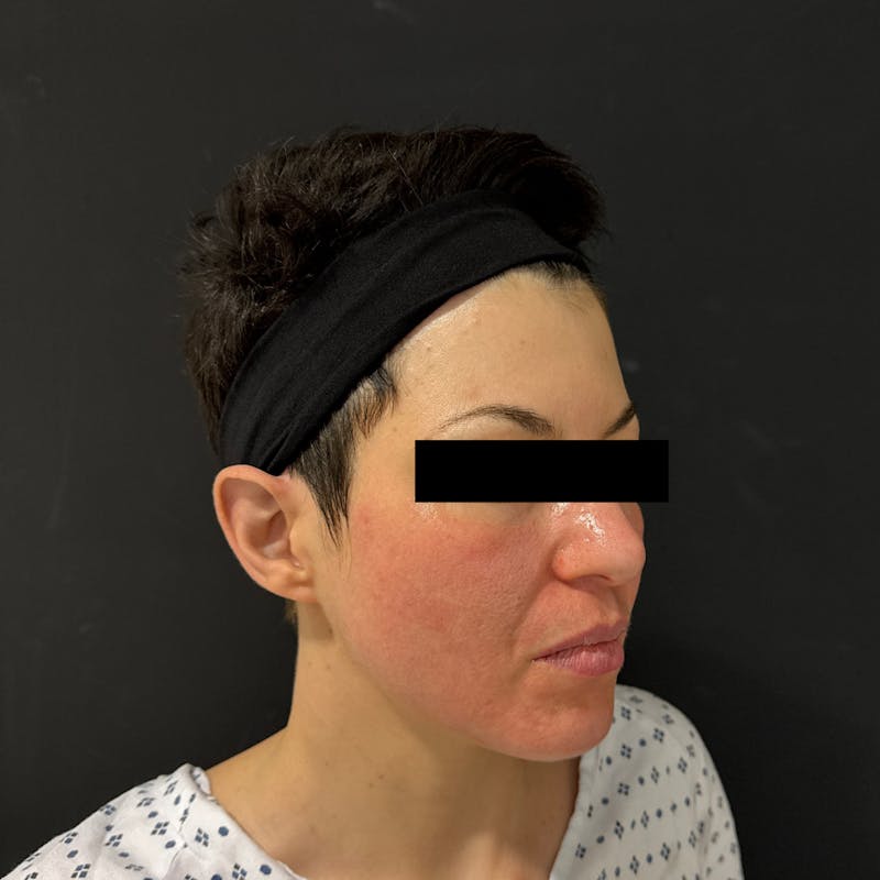 Fat Transfer Before & After Gallery - Patient 341514 - Image 3