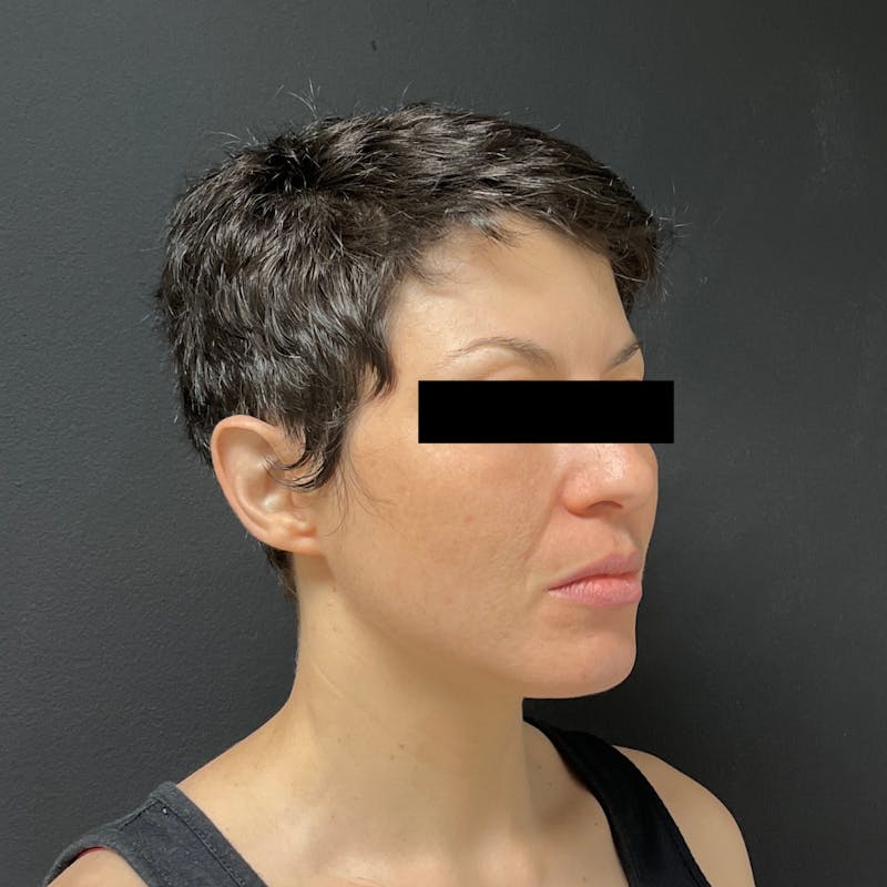 Fat Transfer Before & After Gallery - Patient 341514 - Image 4