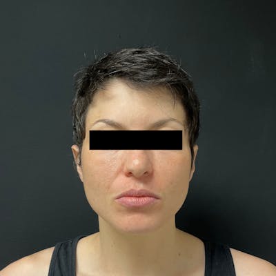 Fat Transfer Before & After Gallery - Patient 341514 - Image 2