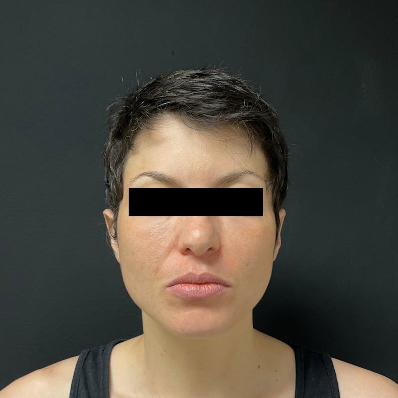 Fat Transfer Before & After Gallery - Patient 341514 - Image 2