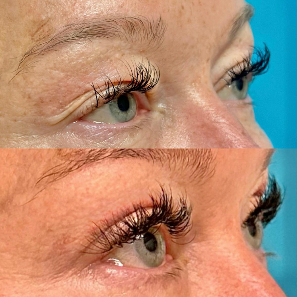 Eyelid Surgery (Blepharoplasty) Before & After Gallery - Patient 930574 - Image 1