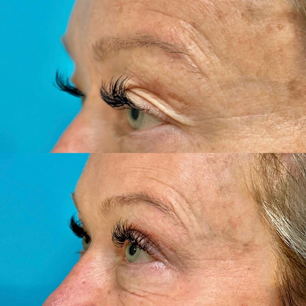 Eyelid Surgery (Blepharoplasty) Before & After Gallery - Patient 930574 - Image 2