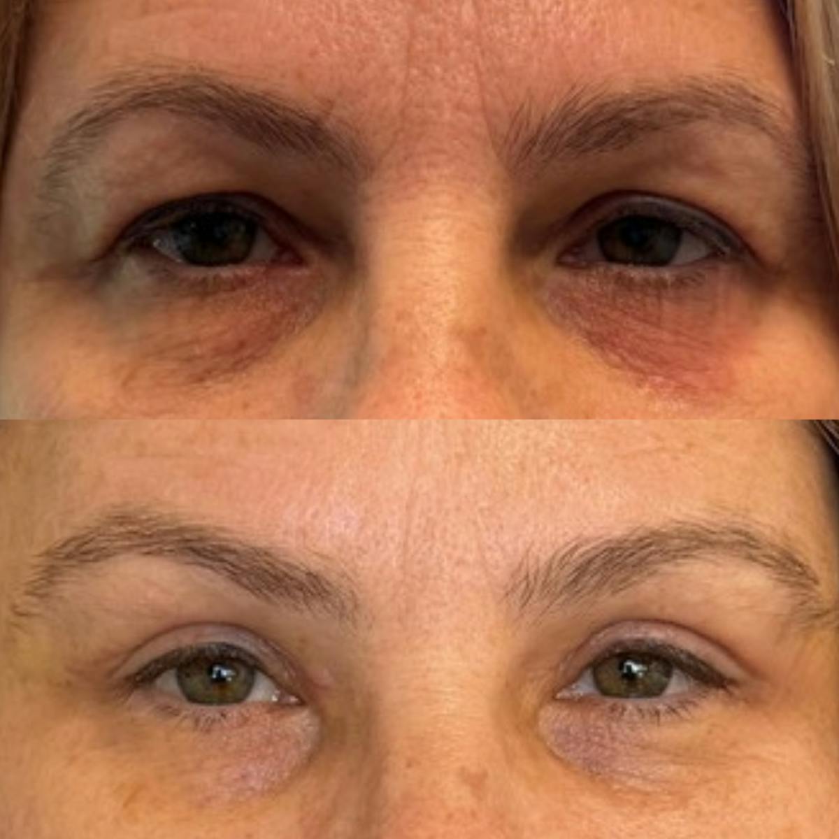 Eyelid Surgery (Blepharoplasty) Before & After Gallery - Patient 376005 - Image 1