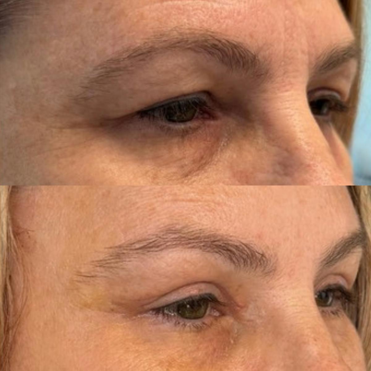 Eyelid Surgery (Blepharoplasty) Before & After Gallery - Patient 376005 - Image 2
