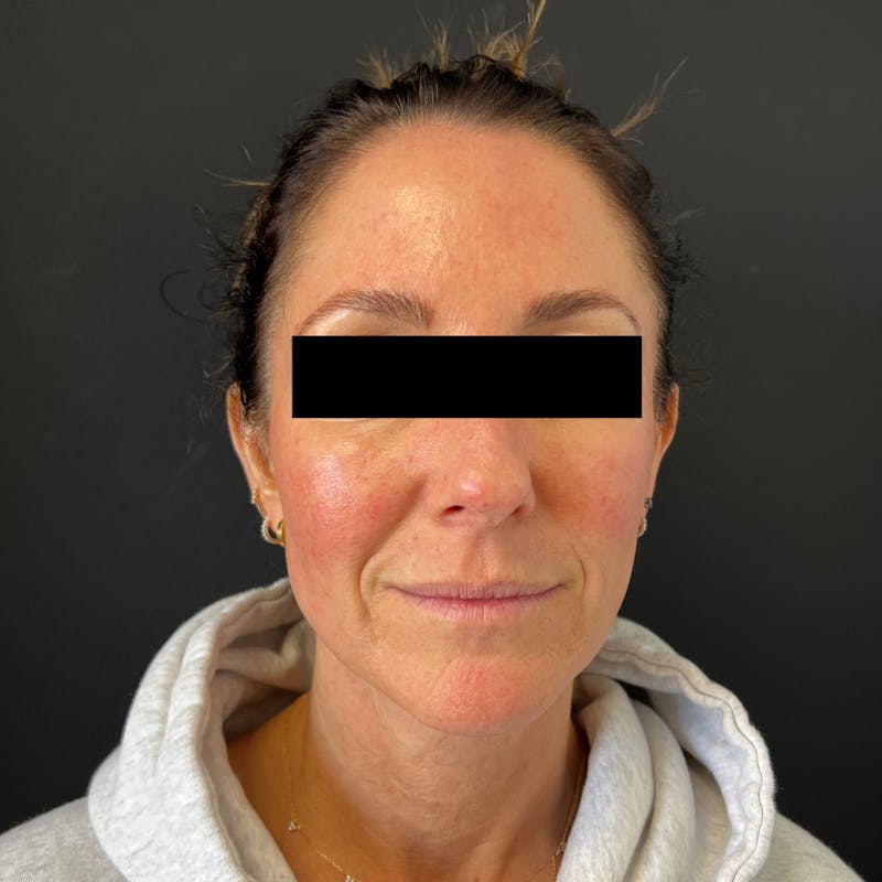 MicroGlo Before & After Gallery - Patient 321154 - Image 1