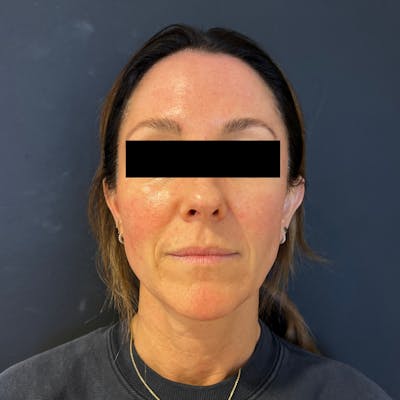 MicroGlo Before & After Gallery - Patient 321154 - Image 2