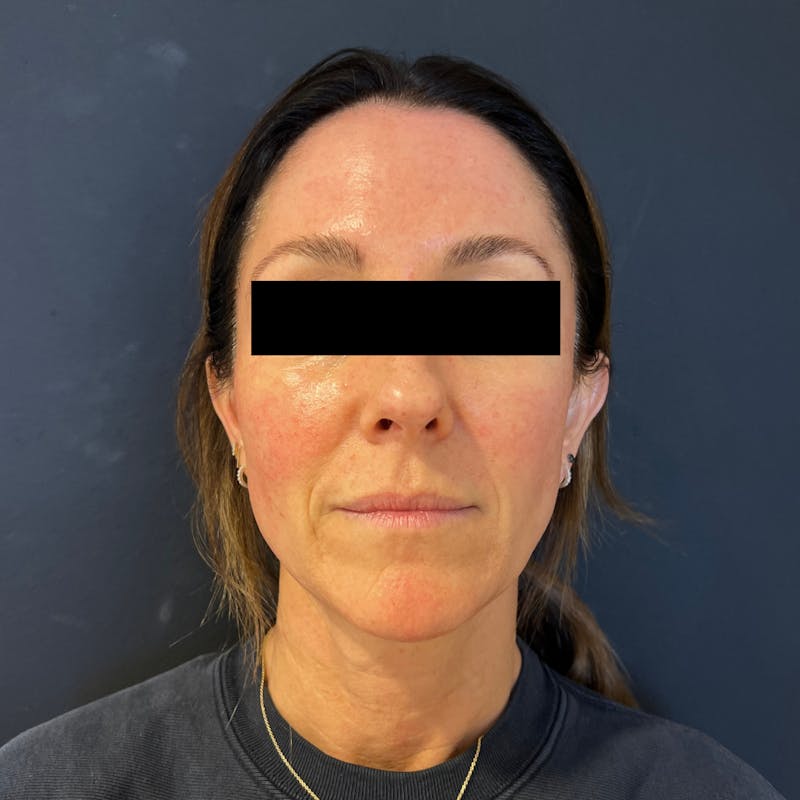 MicroGlo Before & After Gallery - Patient 321154 - Image 2