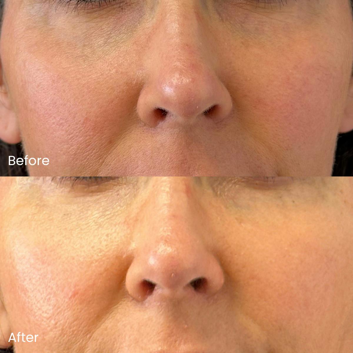 Dermal Fillers Before & After Gallery - Patient 376459 - Image 1