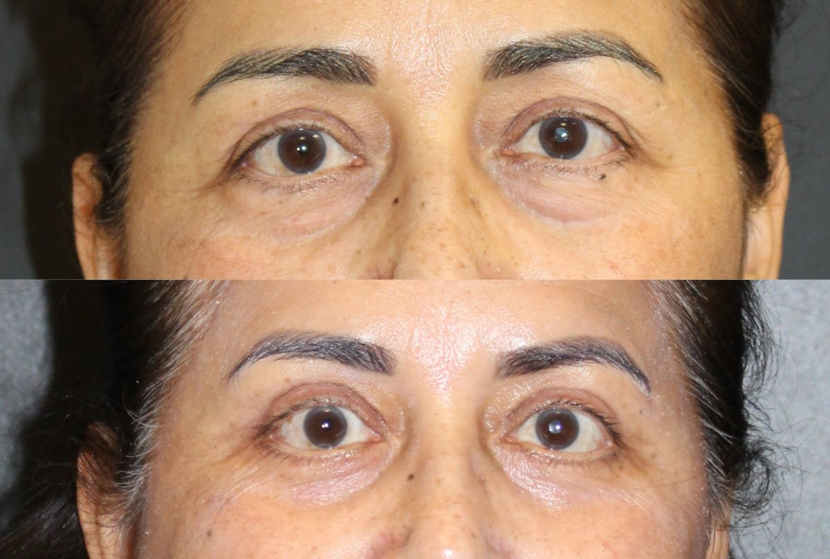 Eyelid Surgery (Blepharoplasty) Before & After Gallery - Patient 813568 - Image 1