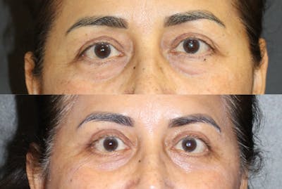 Eyelid Surgery (Blepharoplasty) Before & After Gallery - Patient 813568 - Image 1