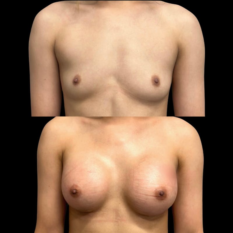 Breast Augmentation Before & After Gallery - Patient 322307 - Image 1