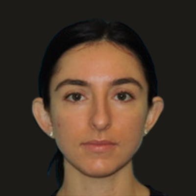 Otoplasty Before & After Gallery - Patient 180267 - Image 1