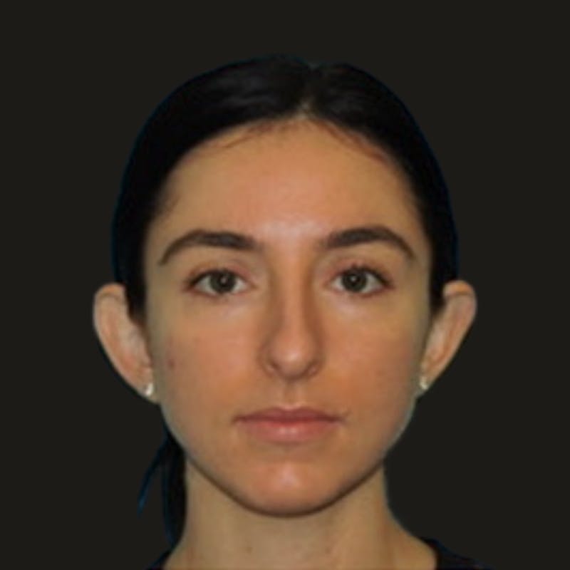 Otoplasty Before & After Gallery - Patient 180267 - Image 1