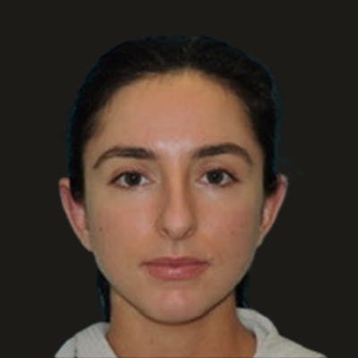 Otoplasty Before & After Gallery - Patient 180267 - Image 2