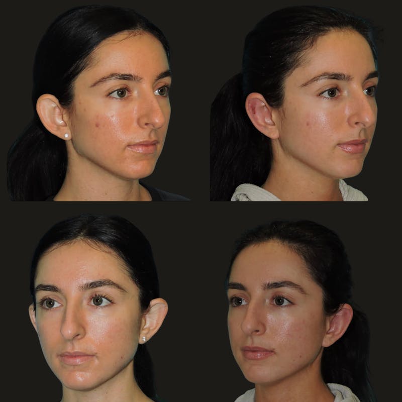 Otoplasty Before & After Gallery - Patient 180267 - Image 3