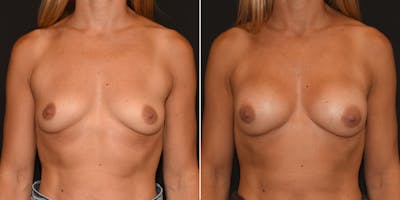 Preservé™ Breast Enhancement Before & After Gallery - Patient 342541 - Image 1