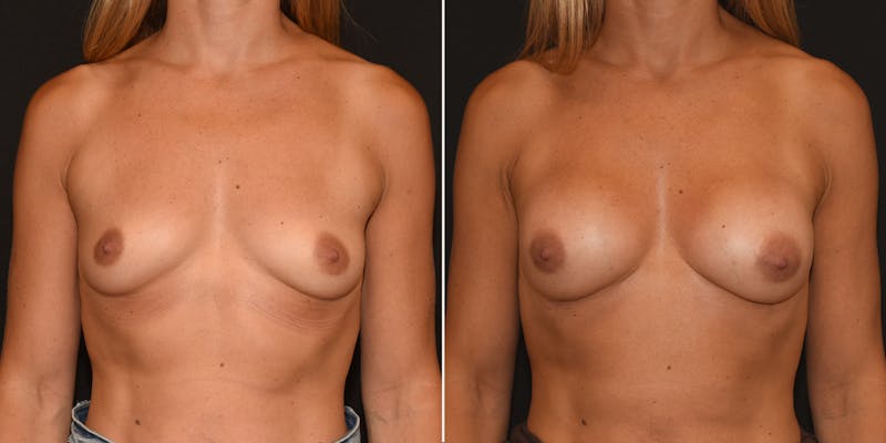Preservé™ Breast Enhancement Before & After Gallery - Patient 342541 - Image 1